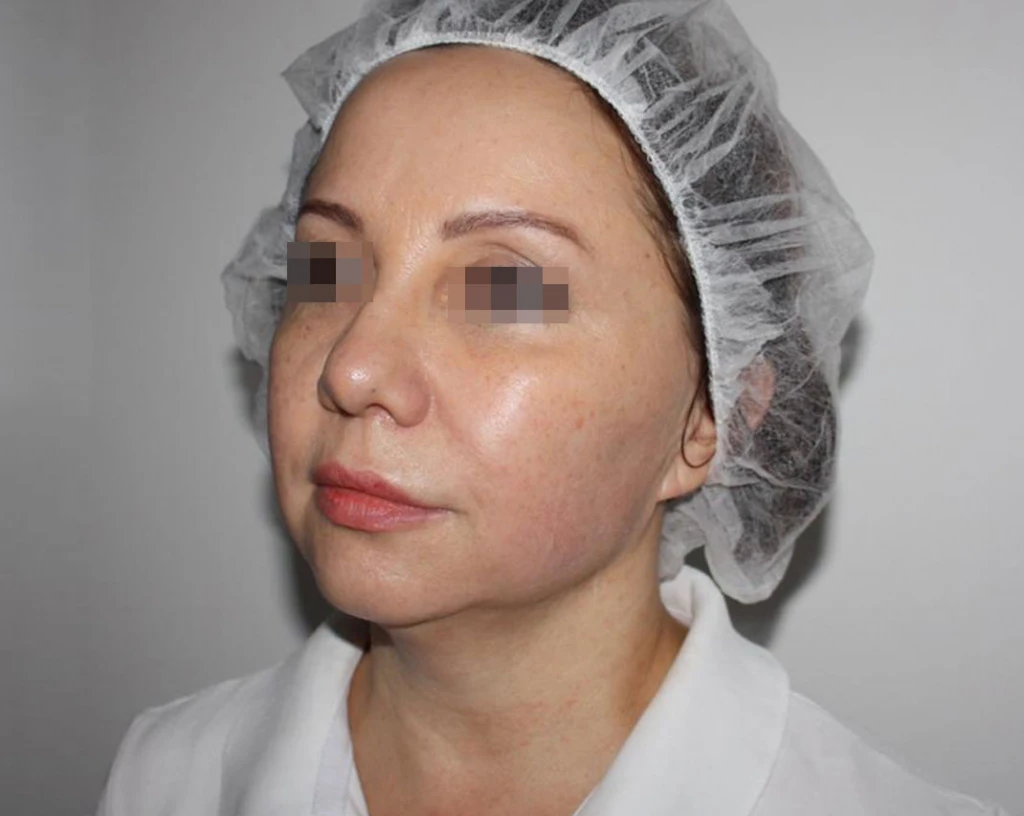 Сочетанное применение Ultherapy и филлерной коррекции