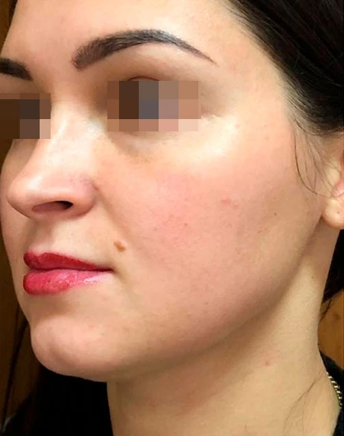 Сочетанное применение Ultherapy, липолитиков и филлерной коррекции