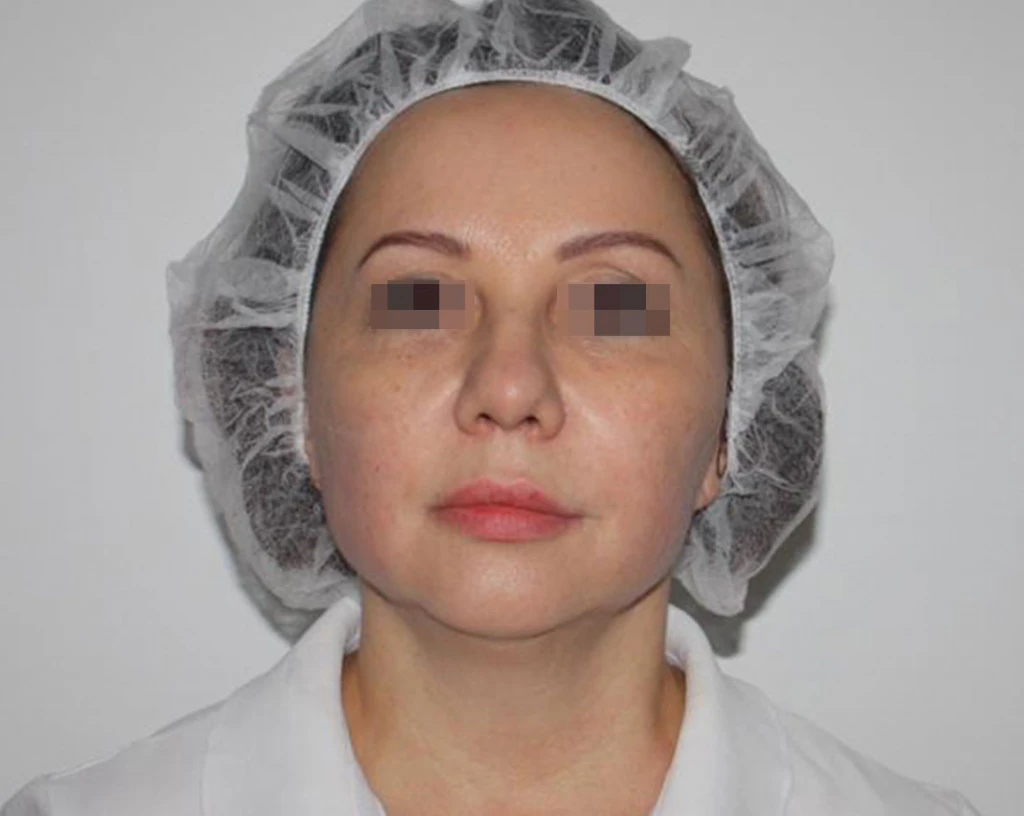 Сочетанное применение Ultherapy и филлерной коррекции