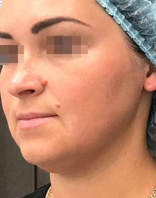 Сочетанное применение Ultherapy, липолитиков и филлерной коррекции