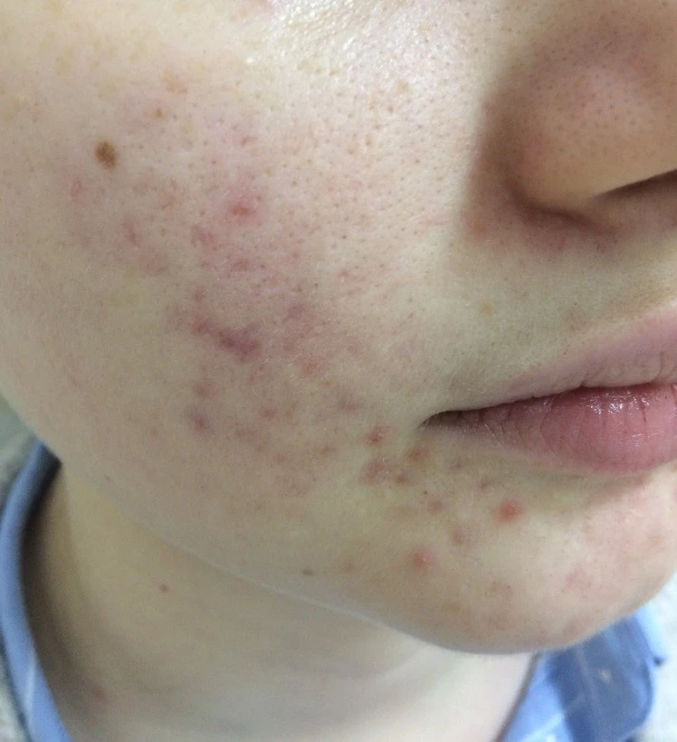 Пилинги Hyalual Peel фото после