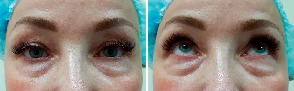 до выполнения лазерной блефаропластики