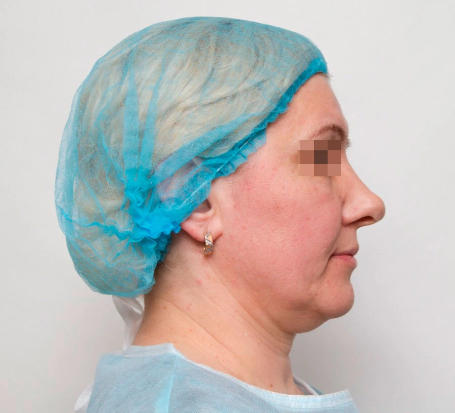 Применение Ultherapy