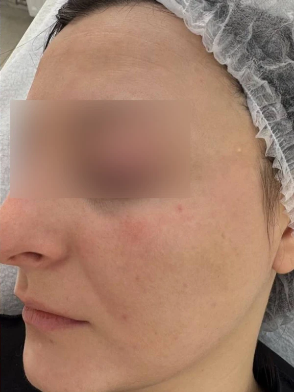 Лазерное лечение гиперпигментации: фото после