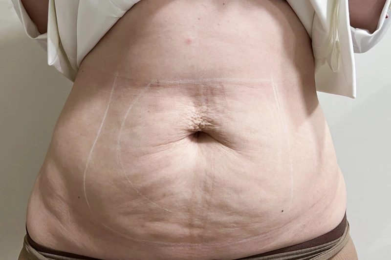 Комбинированный протокол Ulfit + Volnewmer, фото до