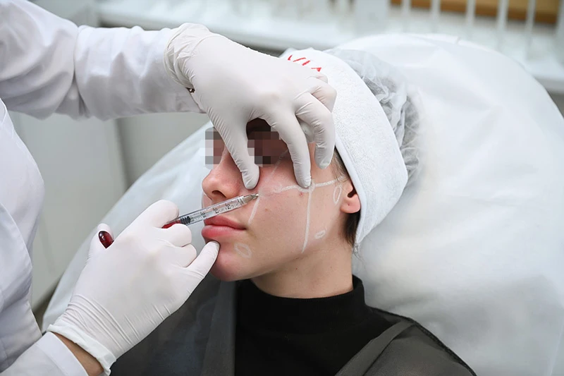 Введение препарата Neauvia Intense Flux