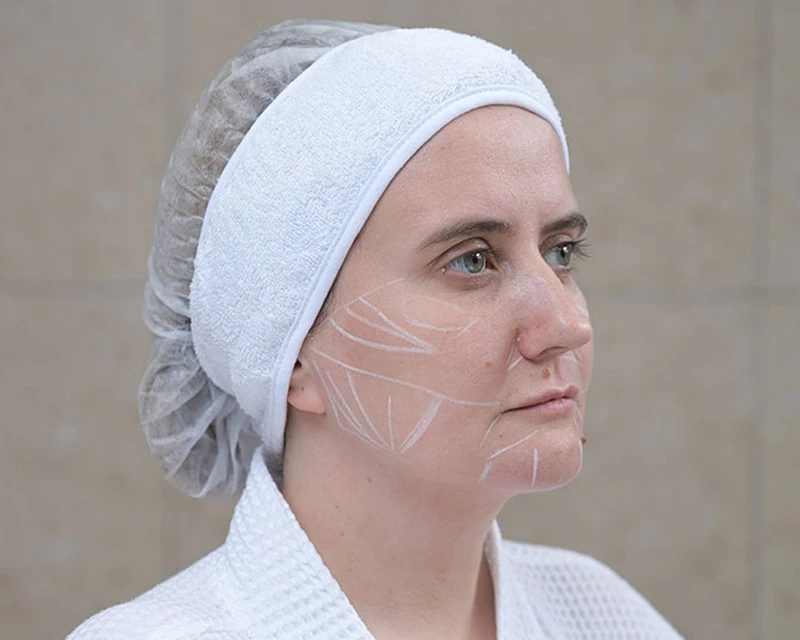 Neauvia Разметка