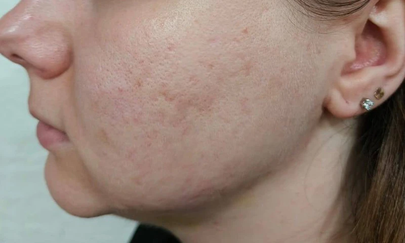 Комбинация пилинга B-Twin System и PRP Cellenis