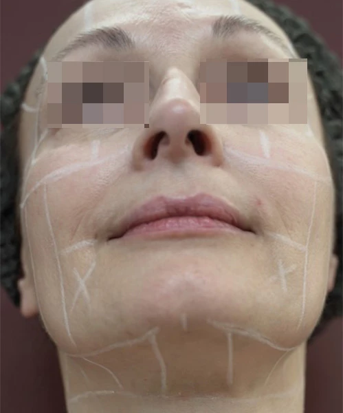 Протокол Альтера-терапия