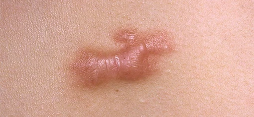 Устранение рубцов