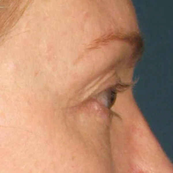 Ulthera System фото до и после