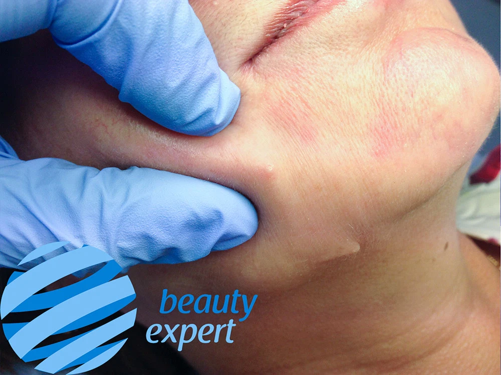 Контурирование концов нитей через кожные покровы