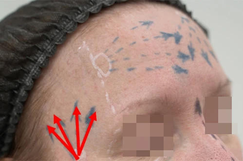 Коррекция препаратом Belotero