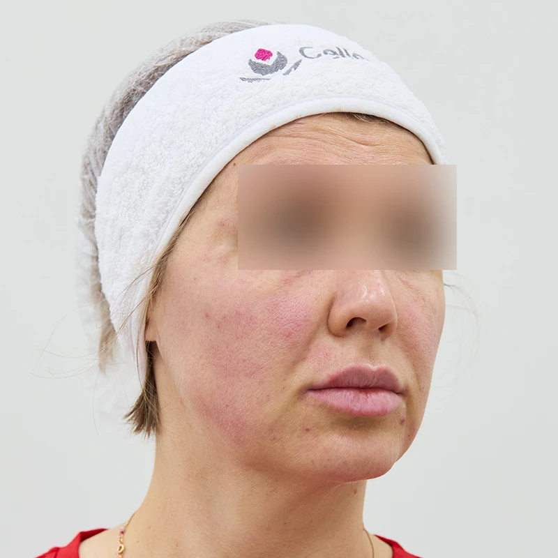Neauvia и Cellenis PRP