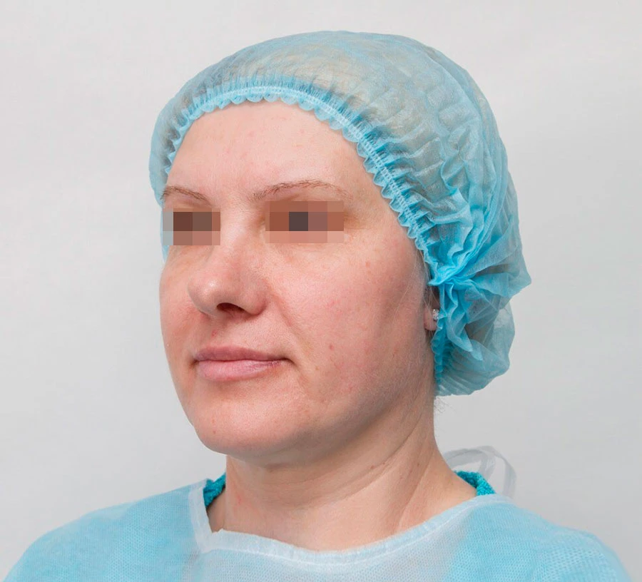 Применение Ultherapy