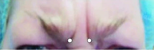 Точки инъекций в m. depressor supercilii