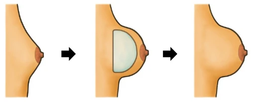 Круглые импланты