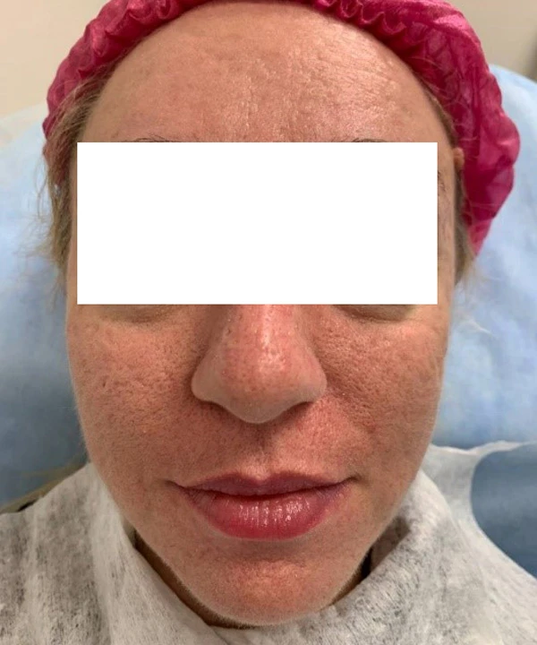 Harmony XL Pro, фото до