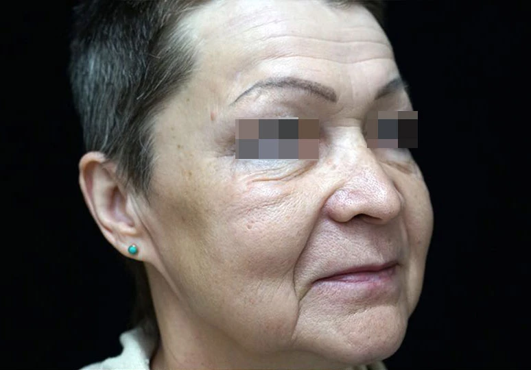 Сочетанное применение Ultherapy и инъекционной коррекции