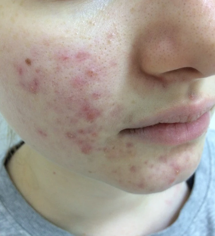 Пилинги Hyalual Peel фото до