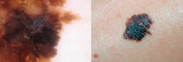 Дерматоскопия