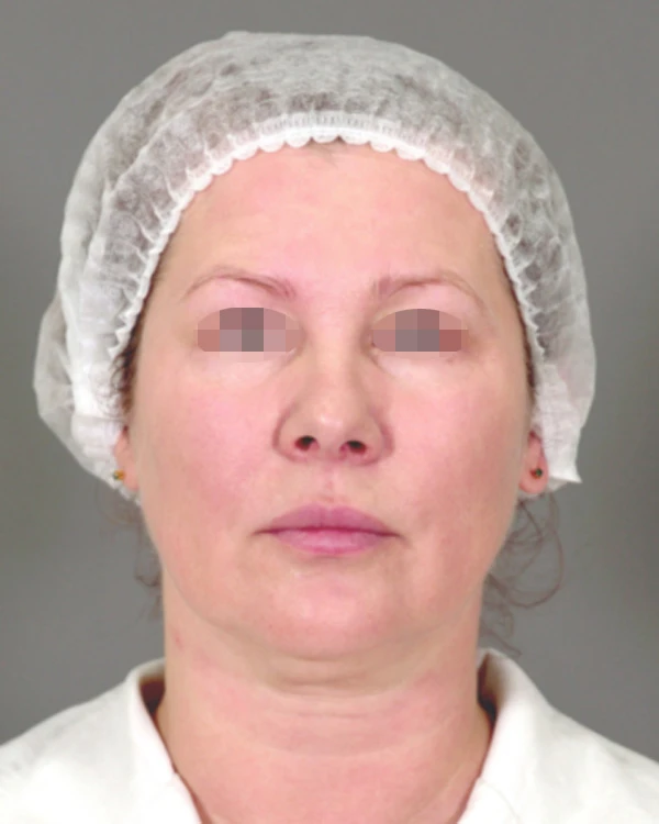 Ксеомин, фото После