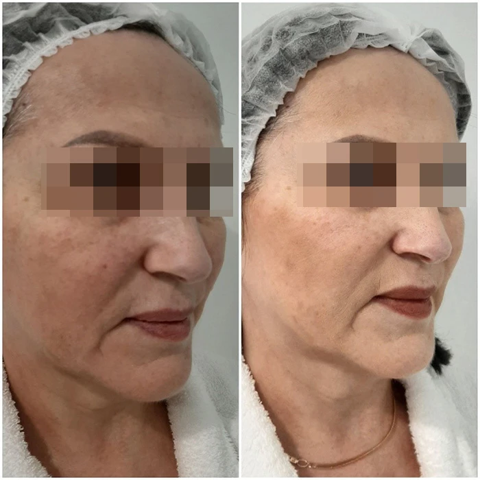 Hyalual 2,2 % и Perfoskin Complex. Фото до и после