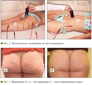 Расположение электродов