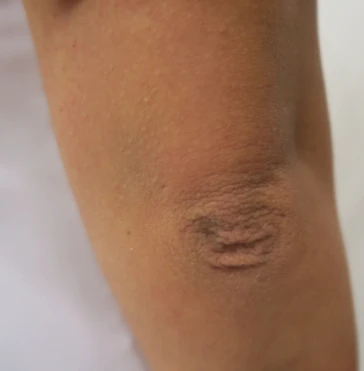 Радиочастотный лифтинг Scarlet RF, фото после