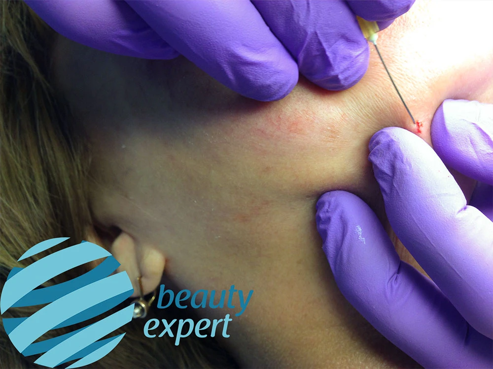 Прокол иглой 18G