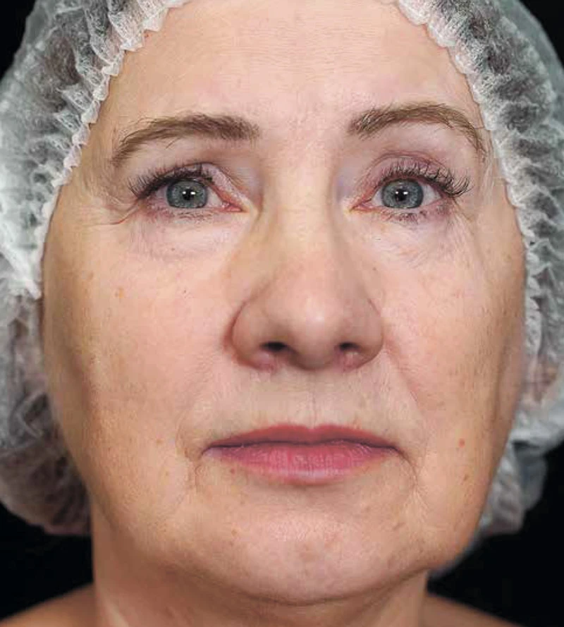 Bioregen + CO₂-лазер