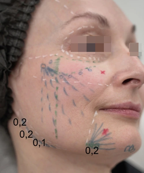 Разметка для инъецирования Radiesse