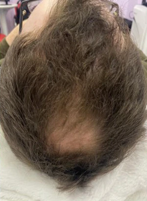 Sylfirm X в лечении алопеции, фото до