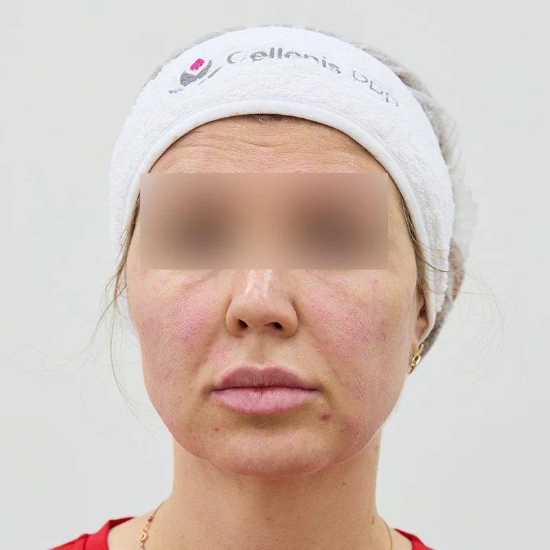 Neauvia и Cellenis PRP