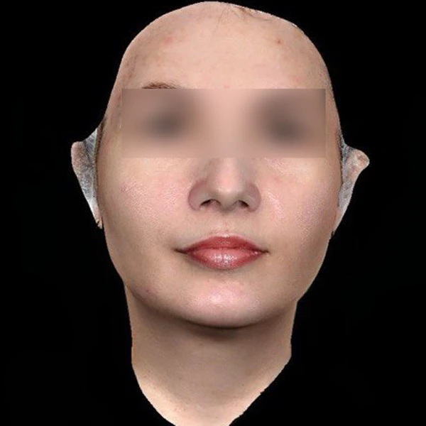 Лазерное лечение гиперпигментации: фото после