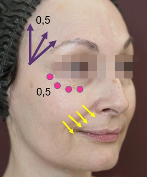 Разметка для инъецирования Belotero