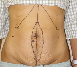 расхождение прямых мышц живота