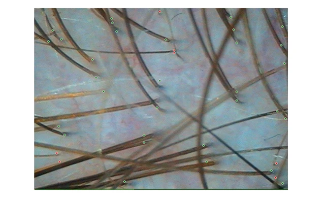 Затылочная зона при андрогенетической алопеции