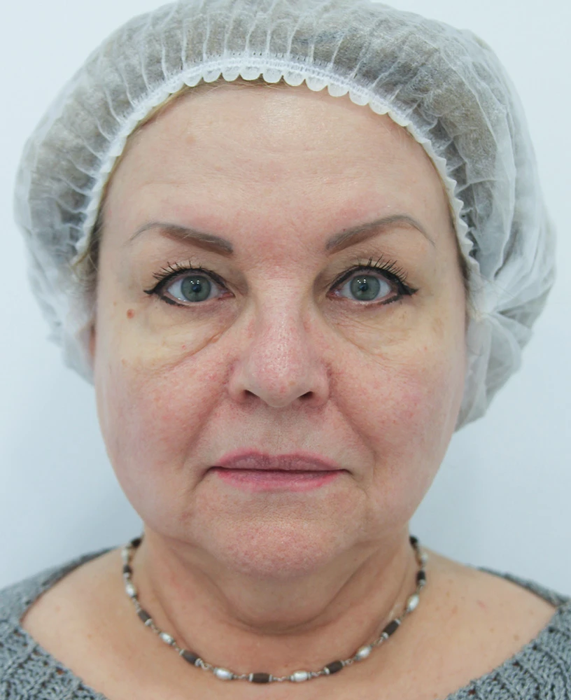 Комбинированный протокол Dye-VL с ClearLift, фото ДО процедуры
