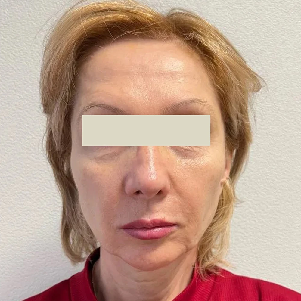 Омоложение лица за одну процедуру