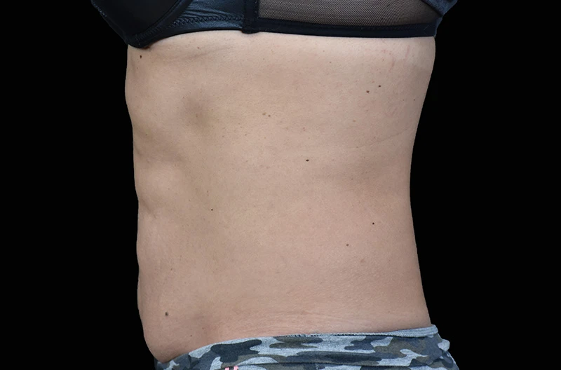 Фото после 6 процедур на аппарате EMSCULPT