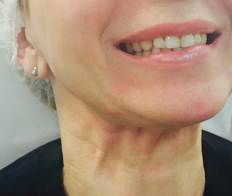 Ксеомин, Тяжи платизмы