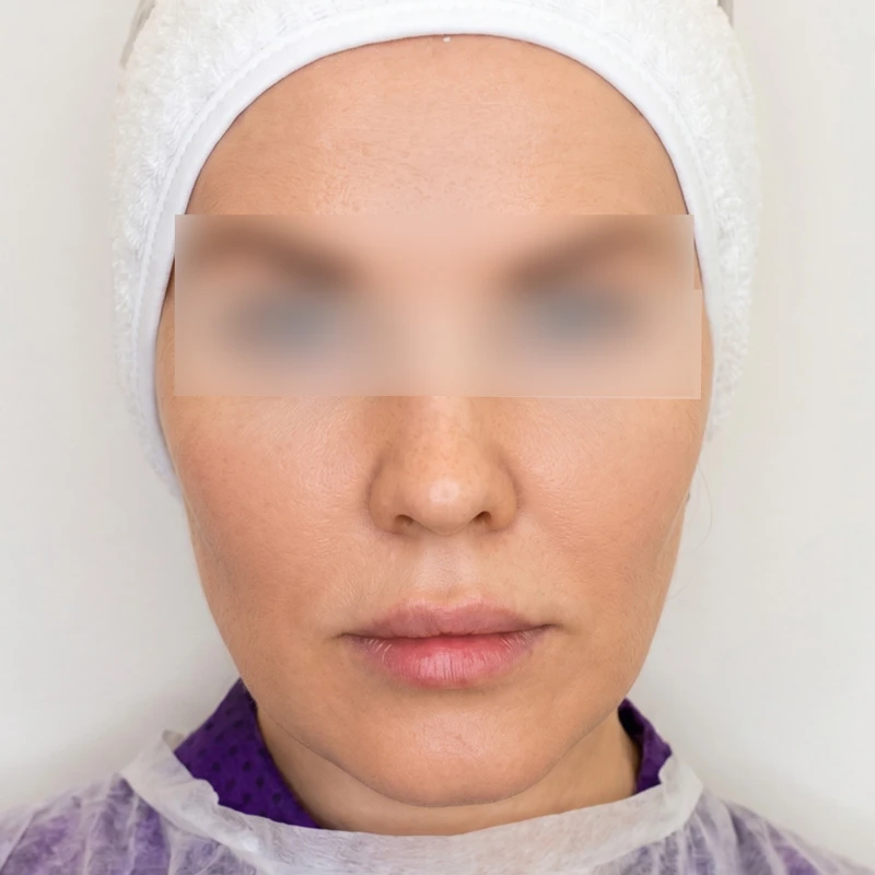 HyalCode Comfort