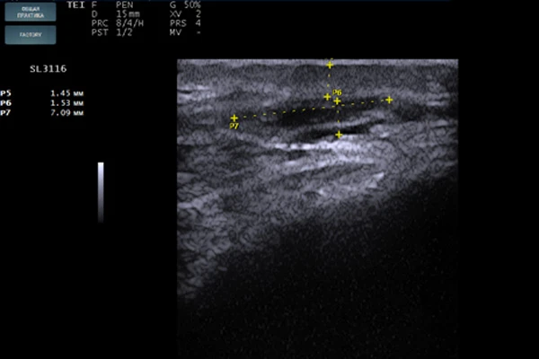 Сонограмма дермального имплантата
