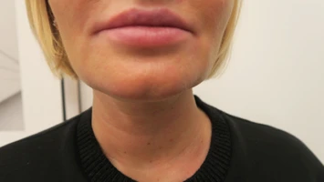 Радиочастотный лифтинг Scarlet RF, фото после