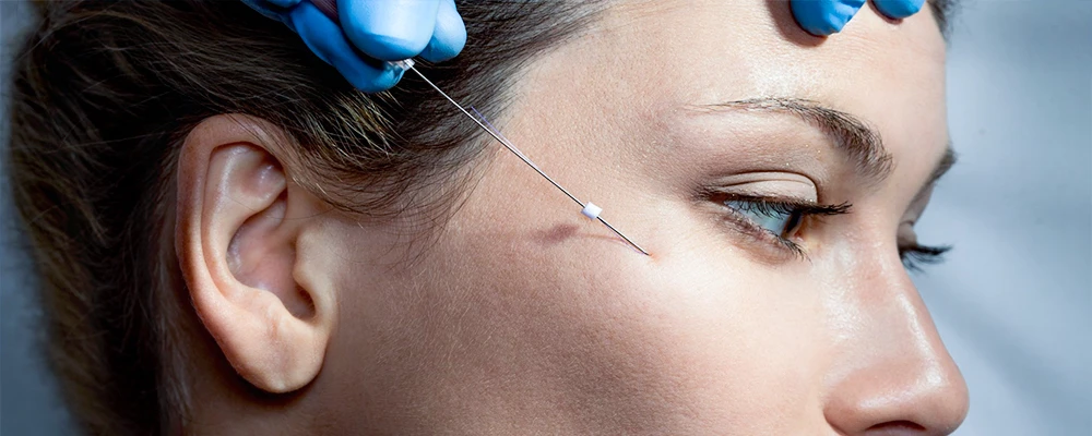 Нитевые подтяжки