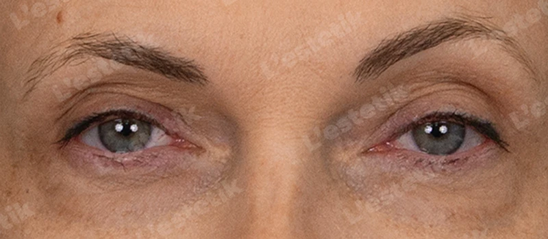 RF-лифтинг Ashley, фото После