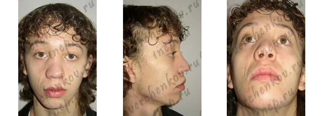 западение спинки носа хрящевого отдела