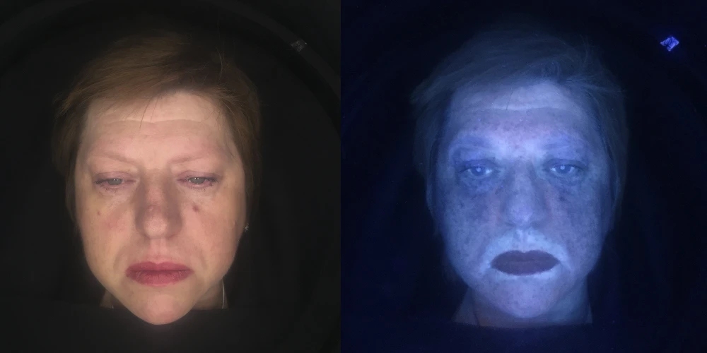 Жирная себорея кожи лица умеренной степени