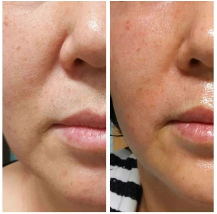 Аппарат INUS. Фото до и после